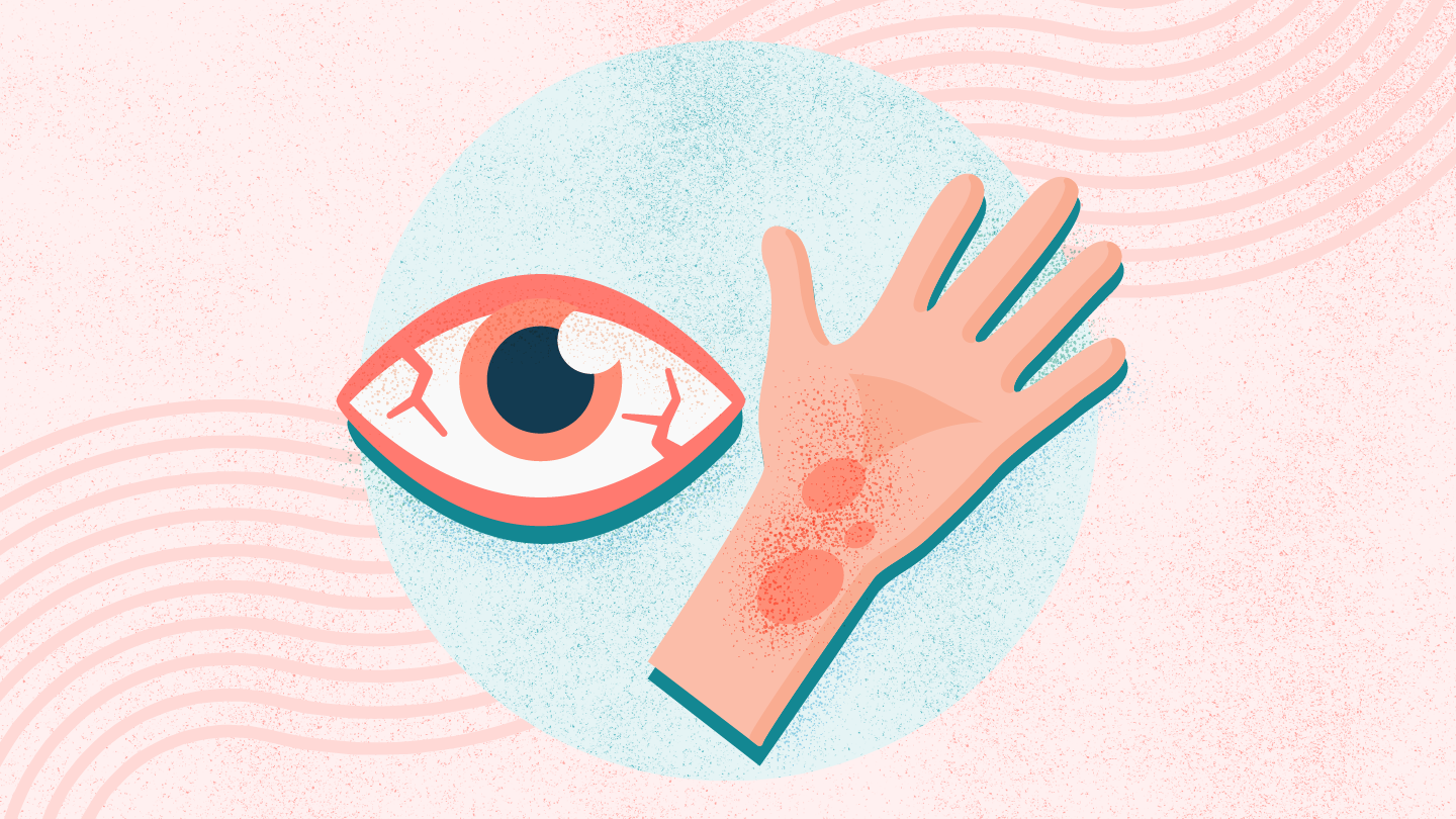 Allergia – Amikor a test tévesen védekezik