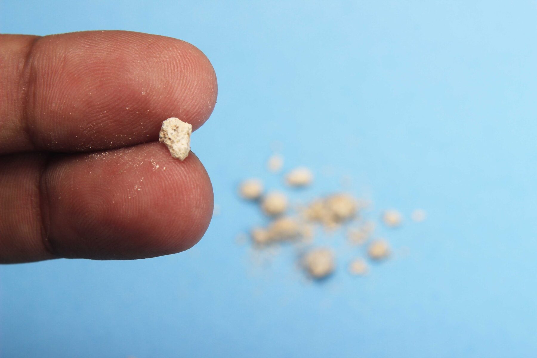 Fájdalom a derékban? – Lehet, hogy vesekő az oka