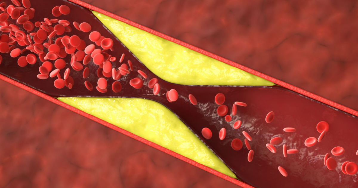 Orvosi tévhitek: Az igazság a koleszterinről
